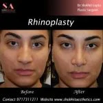 Rhinoplasty Surgery in Delhi NCR, India – Refine Your Look with Dr. Shobhit Gupta Drshobhitaesthetics