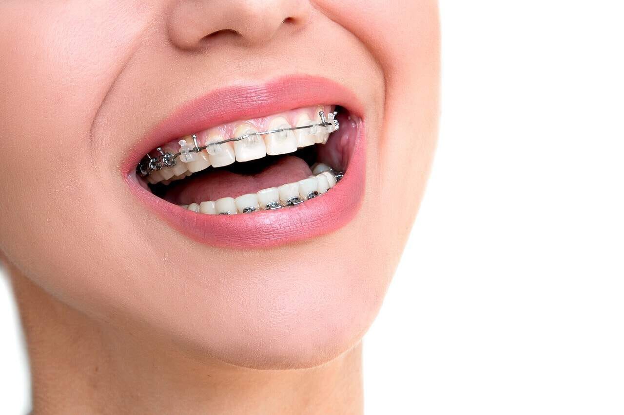 Clear Braces
