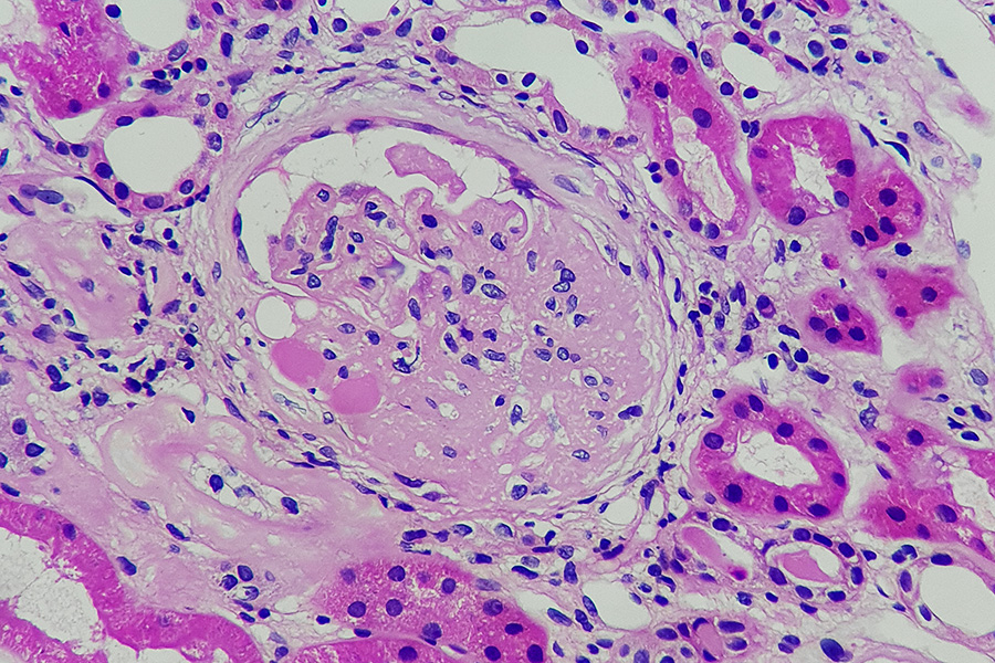 Focal-Segmental-Glomerulosclerosis