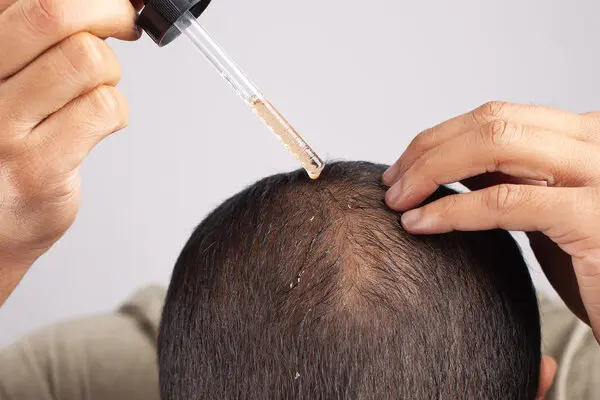 Hair Loss Treatment - Adore Skin Clinic