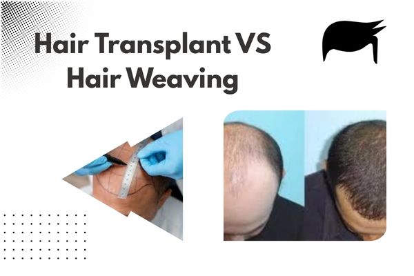 Hair Transplant VS Hair Weaving