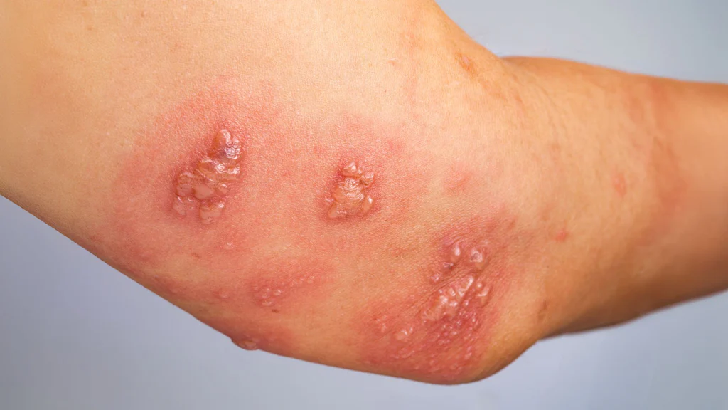Ivermectin for Scabies dosage for Humans