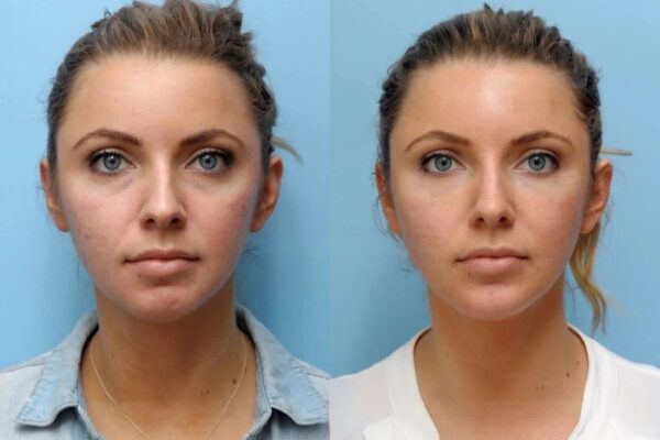Find the Best Plastic Surgeons in Dubai for a Safe, Stunning Thread Lift Find the Best Plastic Surgeons in Dubai for a Safe, Stunning Thread Lift