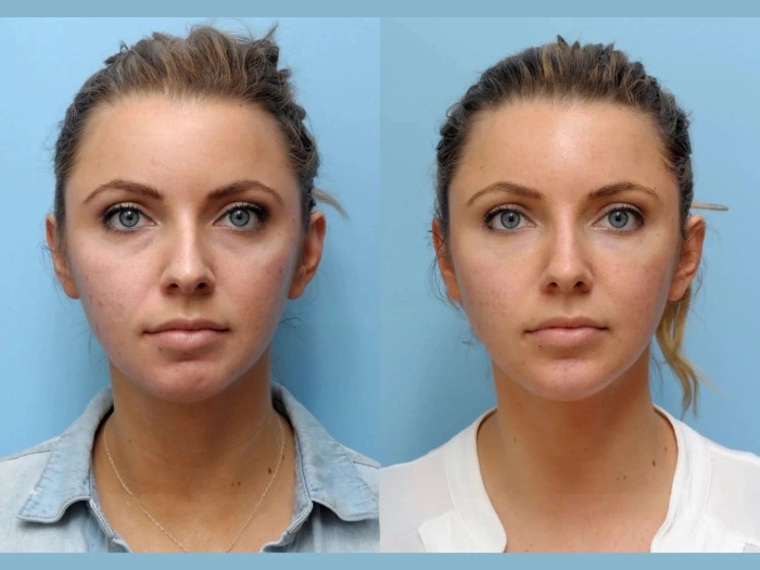 Find the Best Plastic Surgeons in Dubai for a Safe, Stunning Thread Lift