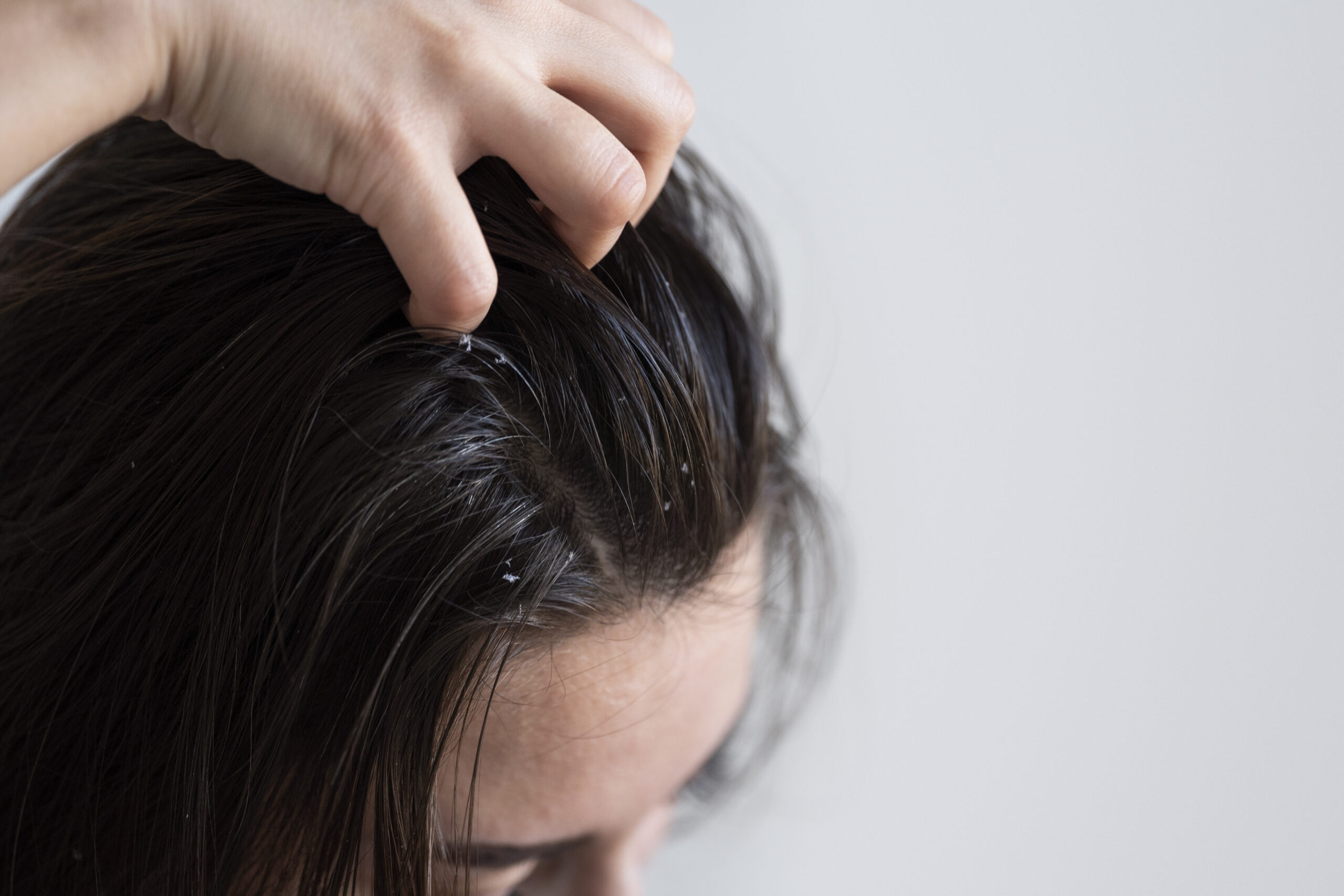 dandruff treatment in Mira Bhayandar