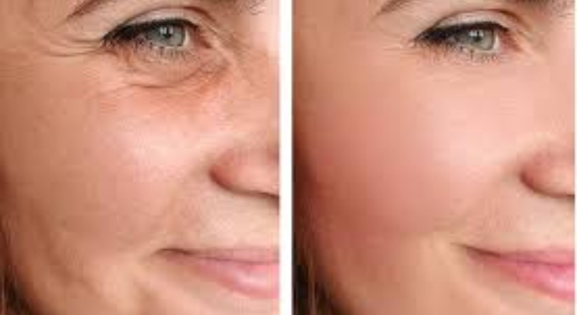 face lift surgery image