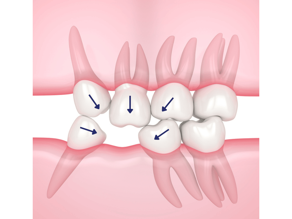missing teeth