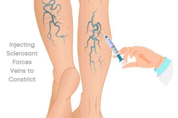 Effective Varicose Veins Treatment Options for Long-Lasting Relief vericose veins treatment