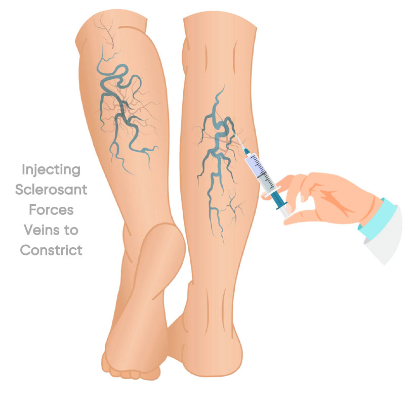 vericose veins treatment