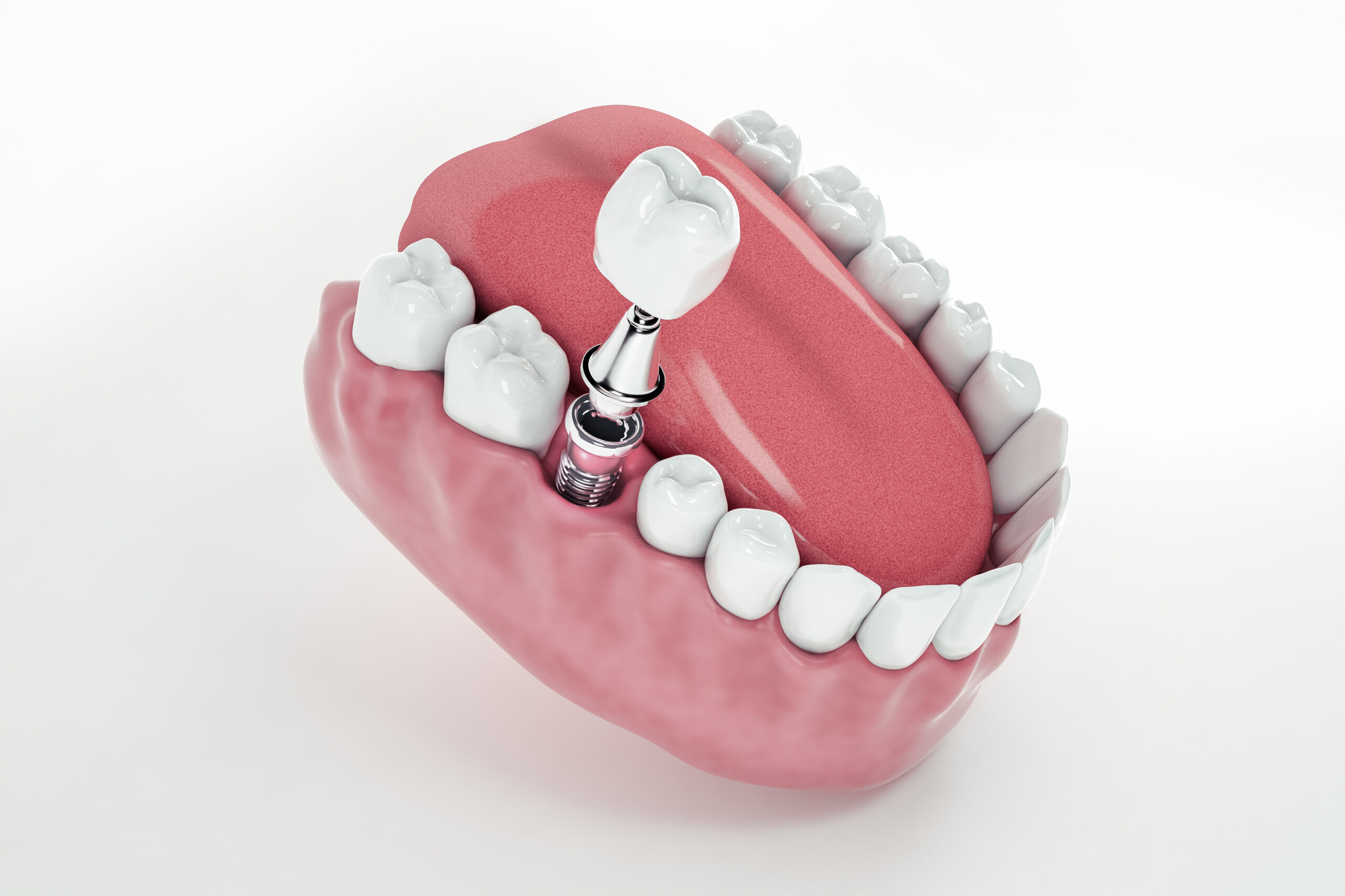 Dental Implant in Indiranagar - Adp