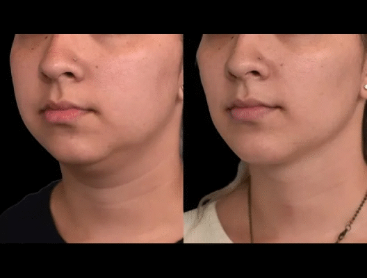 New Year resolutions and double chin removal in Dubai Double chin removal