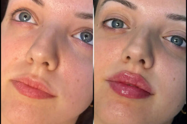 Fillers in Dubai: Breaking the Myths and Misconceptions FILLERS IN DUBAI