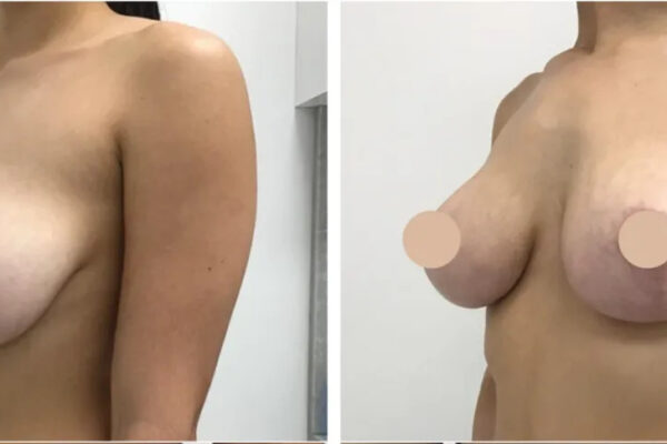 Comparing Breast Reduction Trauma Techniques in Dubai breast reduction in dubai