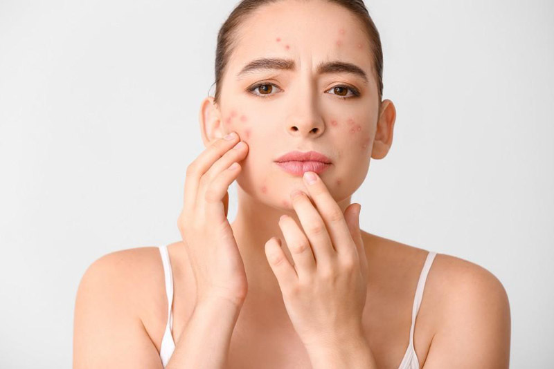 The top causes of acne and how to treat them naturally