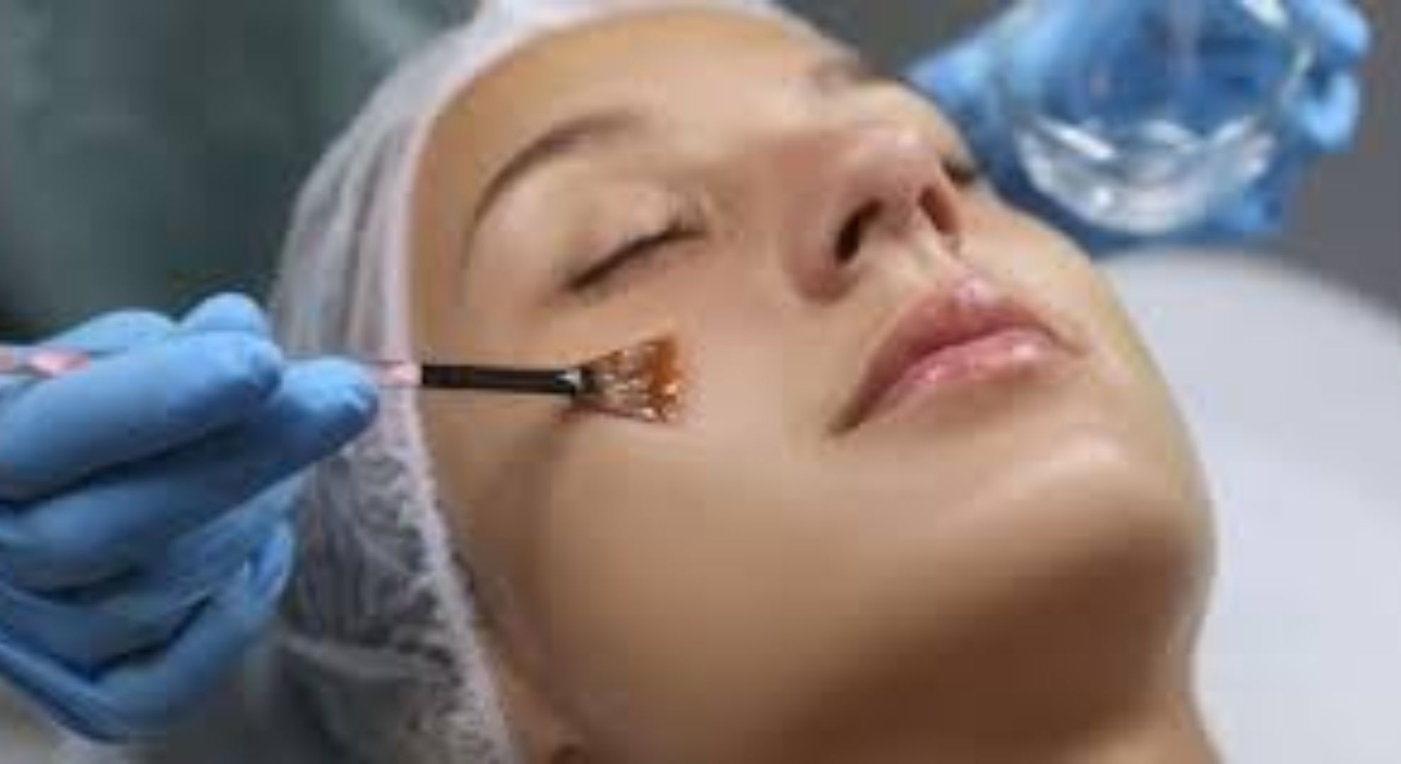 chemical peels treatments images