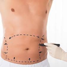 Abdominoplasty in Islamabad – Transform Your Midsection with Confidence