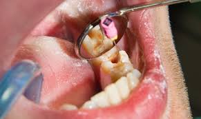 root canal treatment
